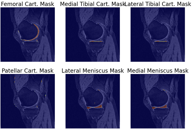 Segmentation of cartilage from knee MRI using AI